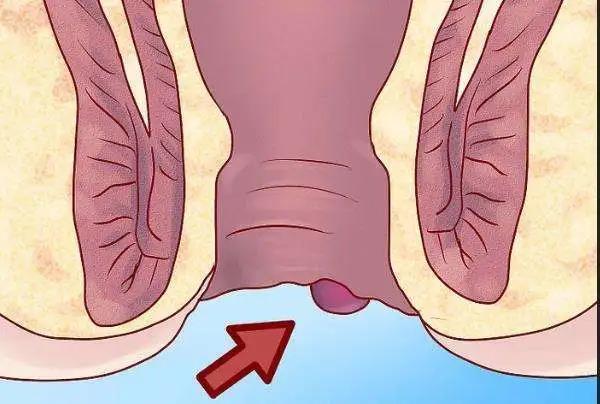 直观的辨别肛门内有无内痔,肛瘘,肛乳头瘤等情况,及时发现诸多早期