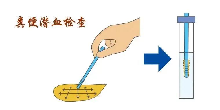 大便隱血篩查腸道健康早預防